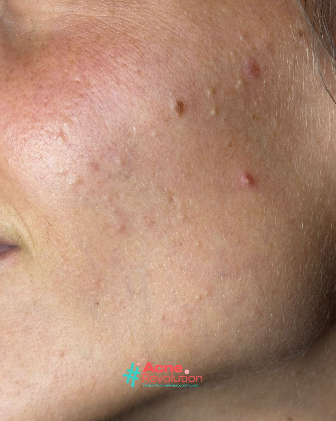 acne comedonica