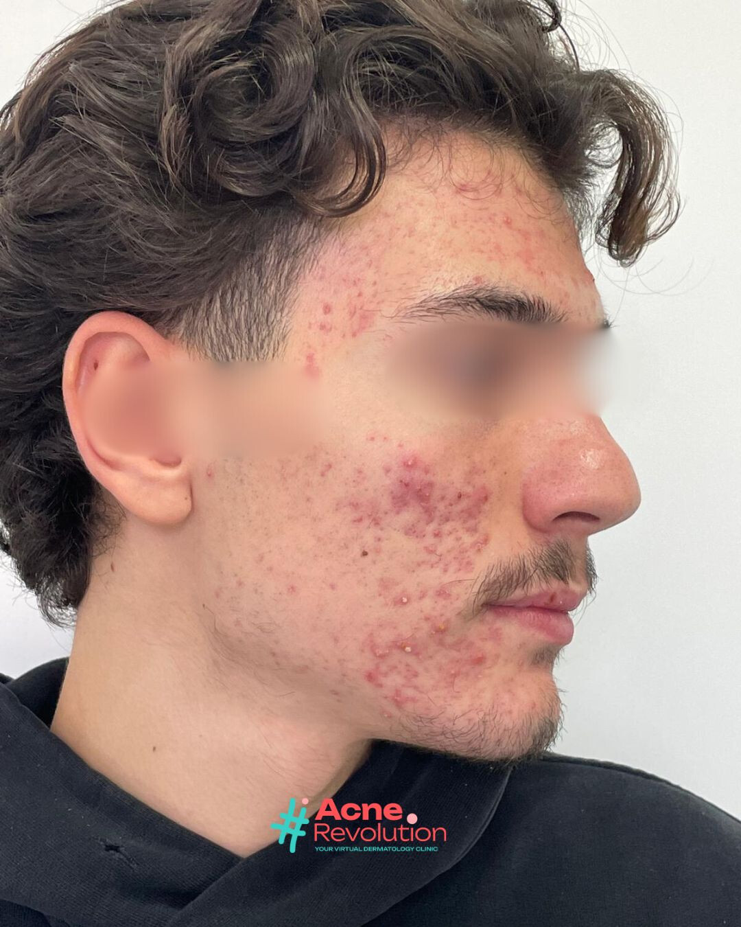 acne polimorfa