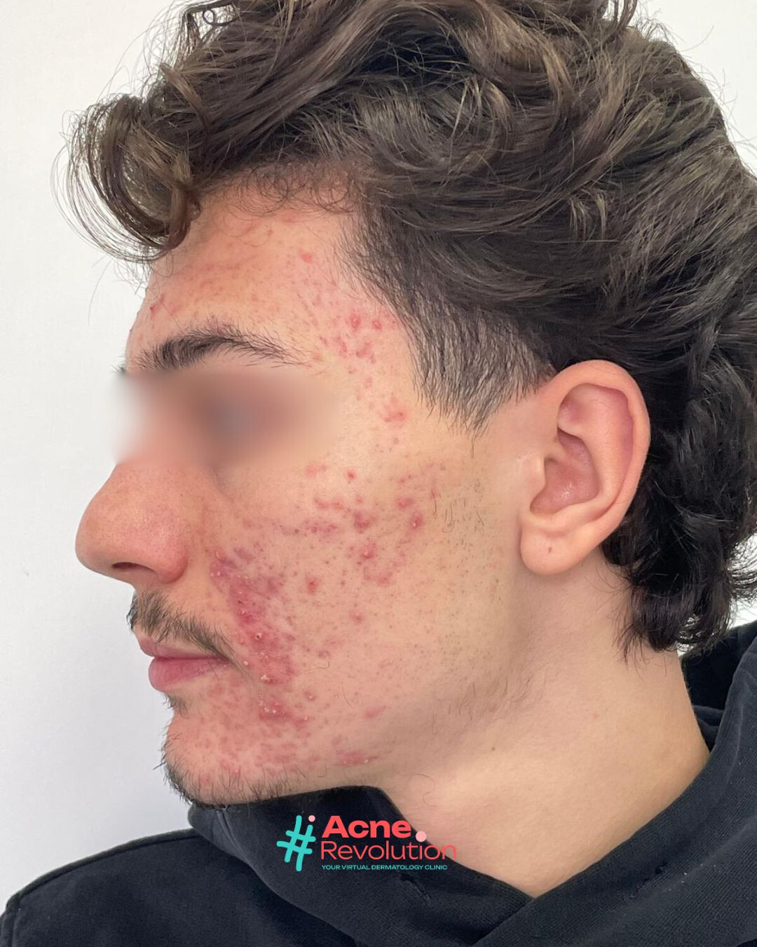 acne polimorfa