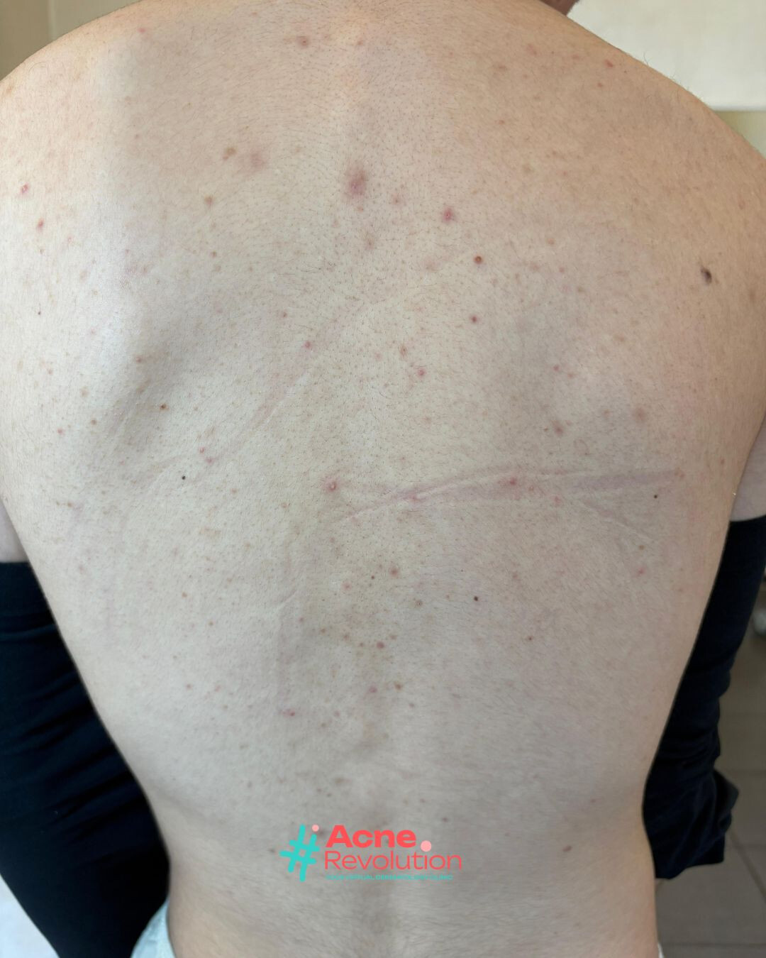 acne di maiorca