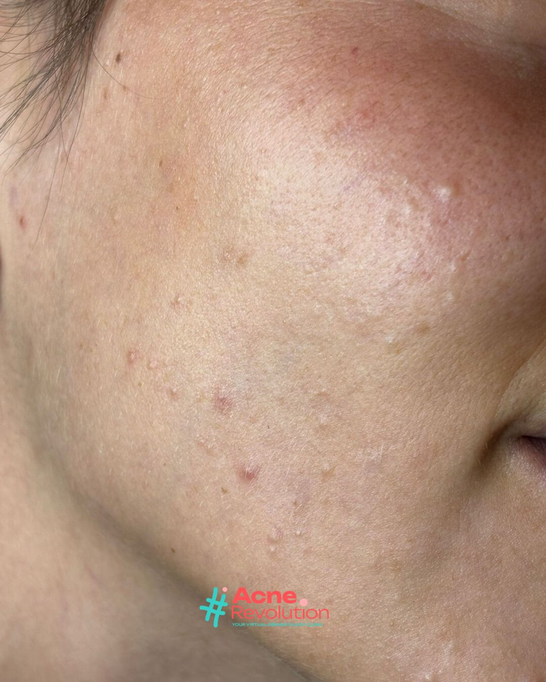 acne comedonica
