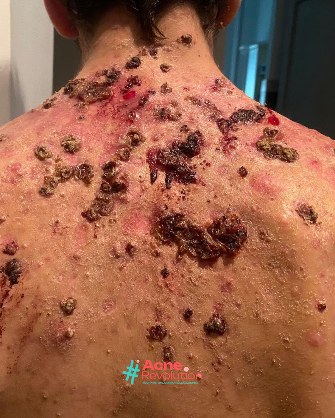 acne fulminante