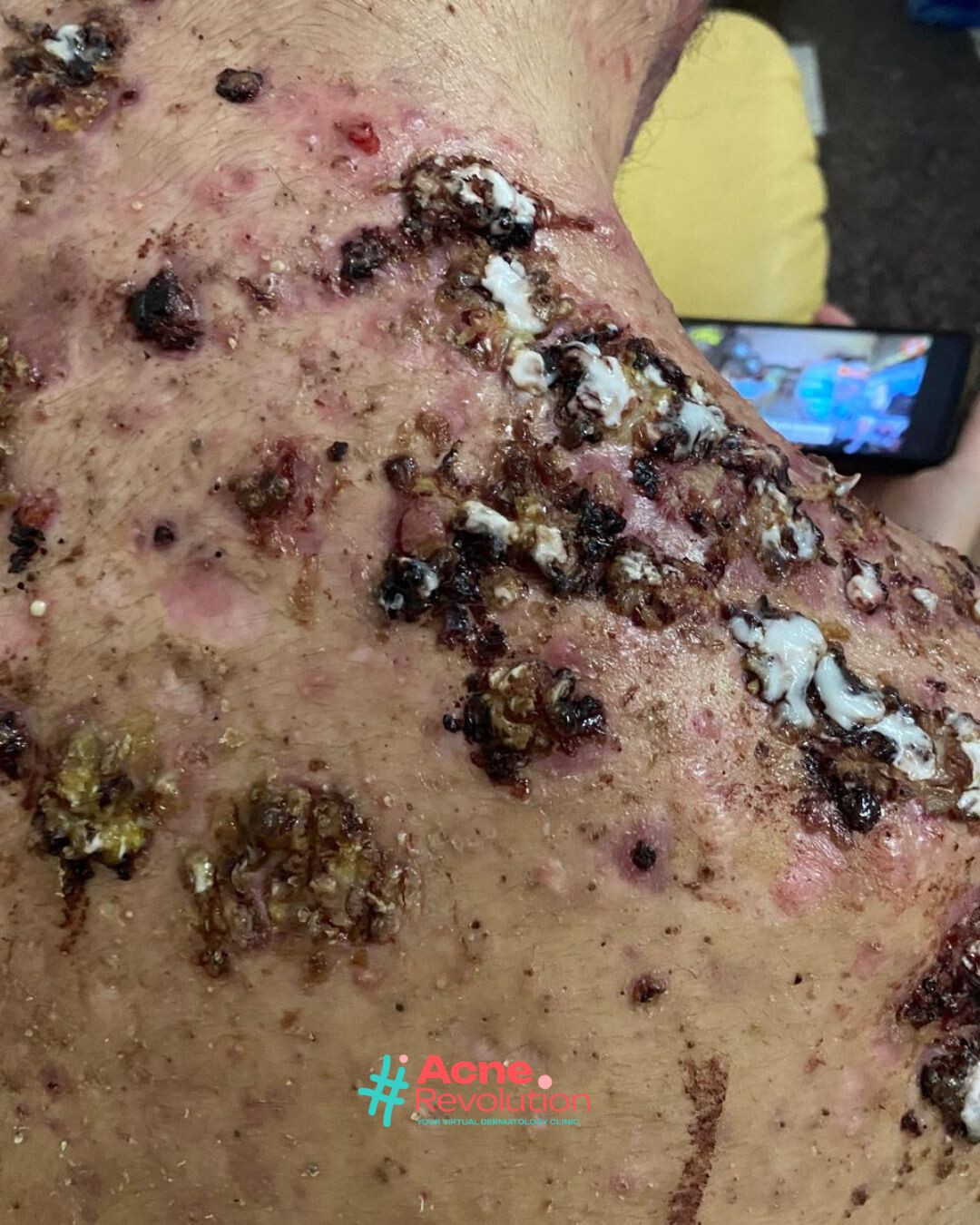 acne fulminante