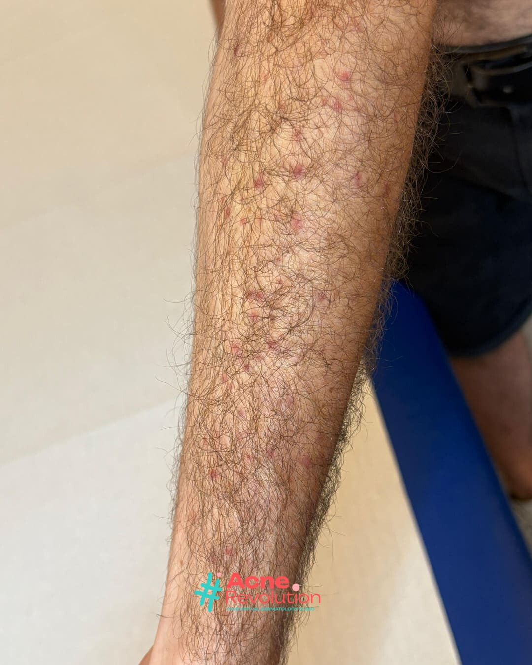 acne da sole