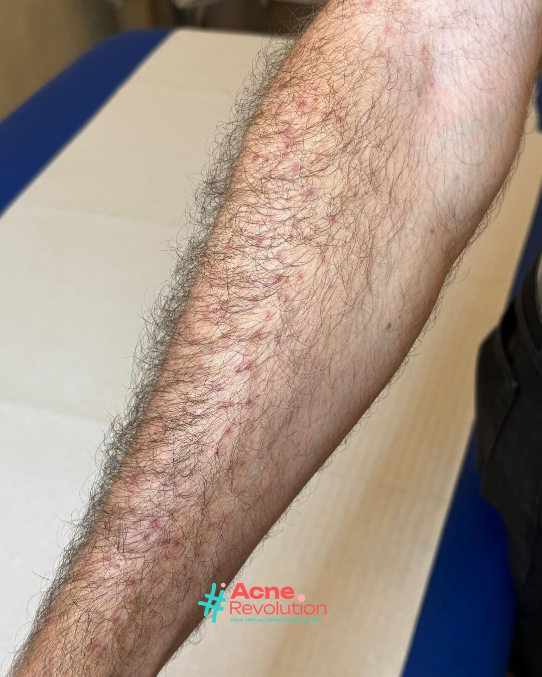 acne da sole