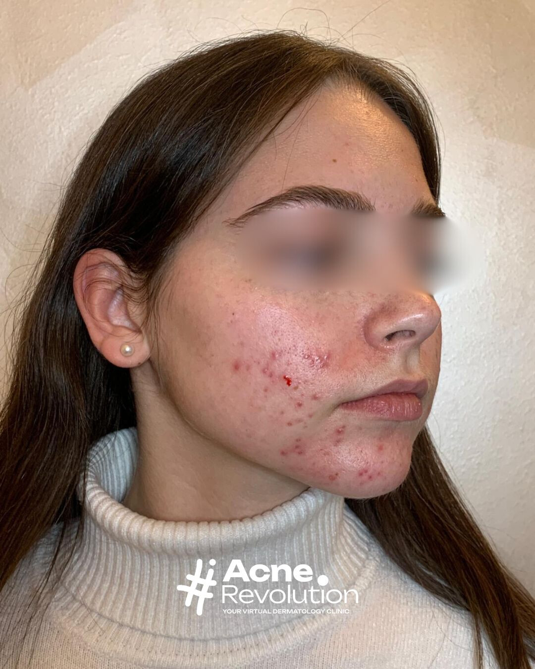 acne da stress