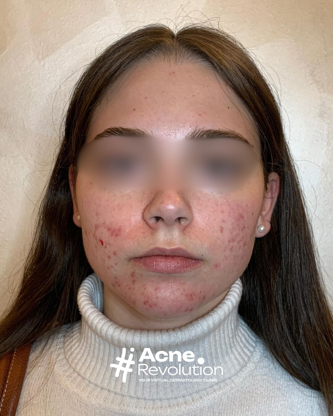acne da stress