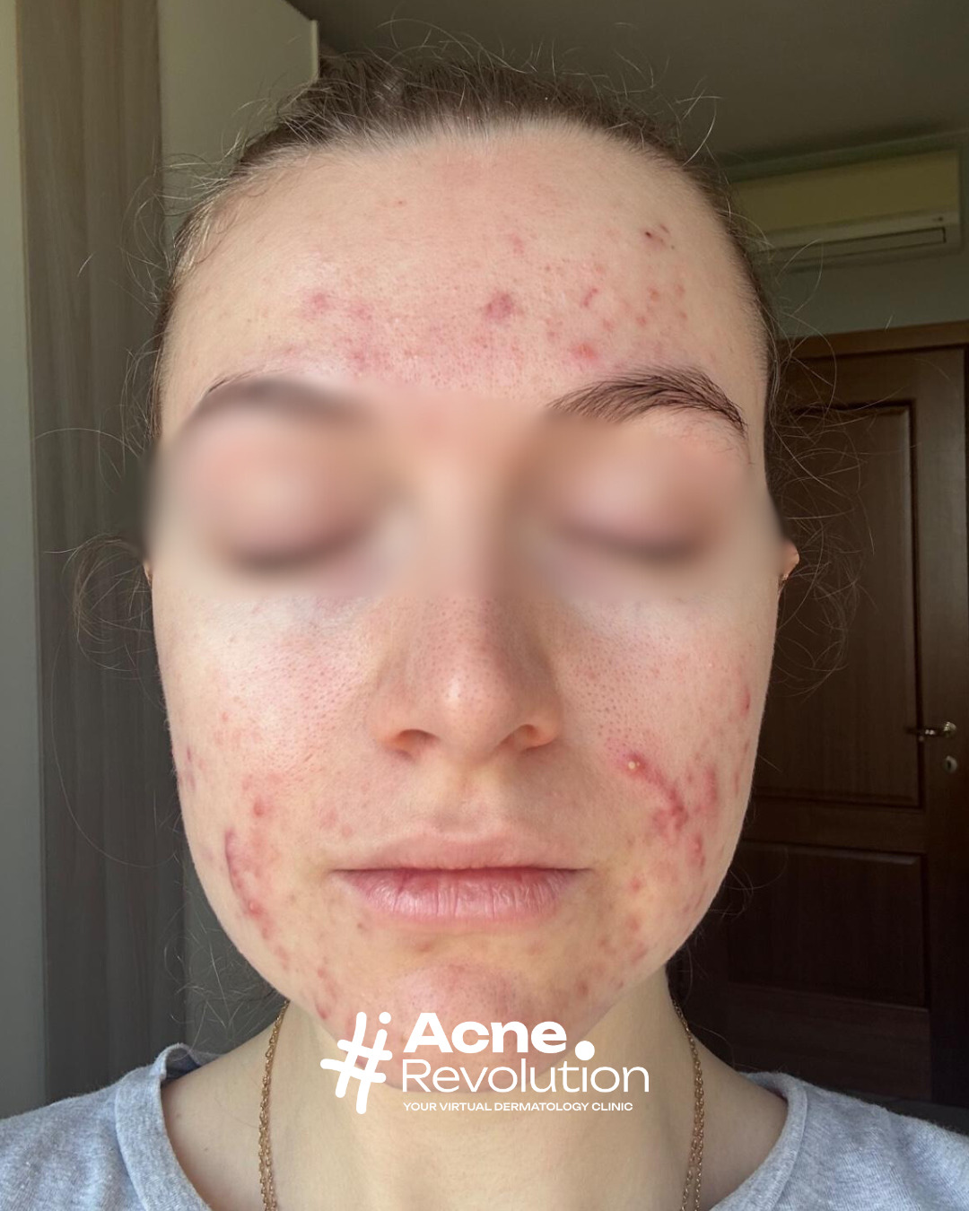 acne fungina