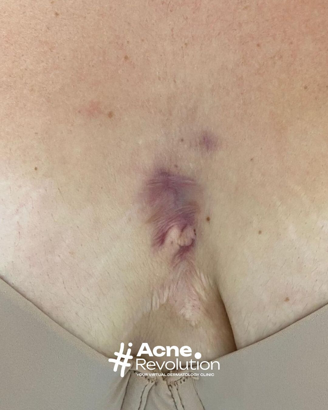 acne inversa