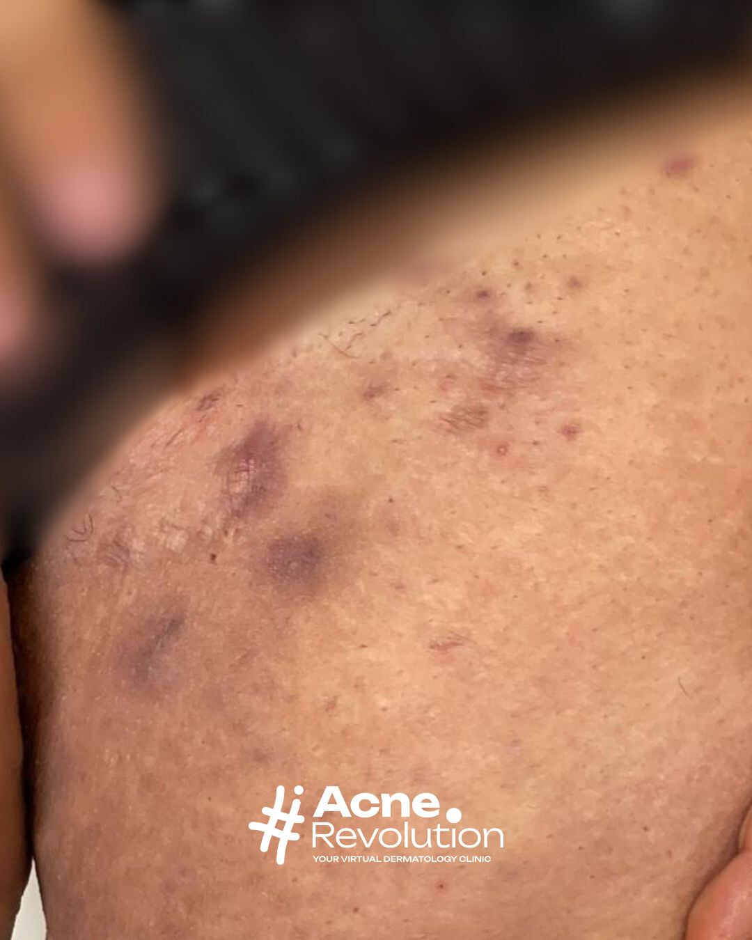 acne inversa
