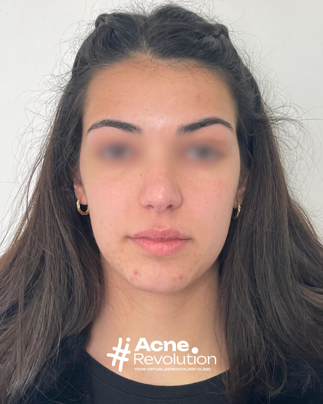 acne sul mento
