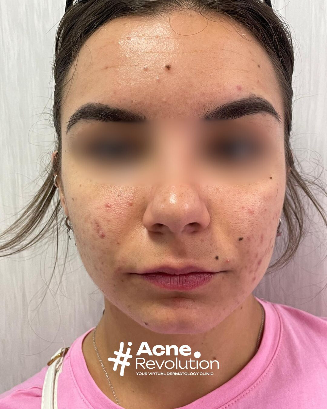 acne seborroica