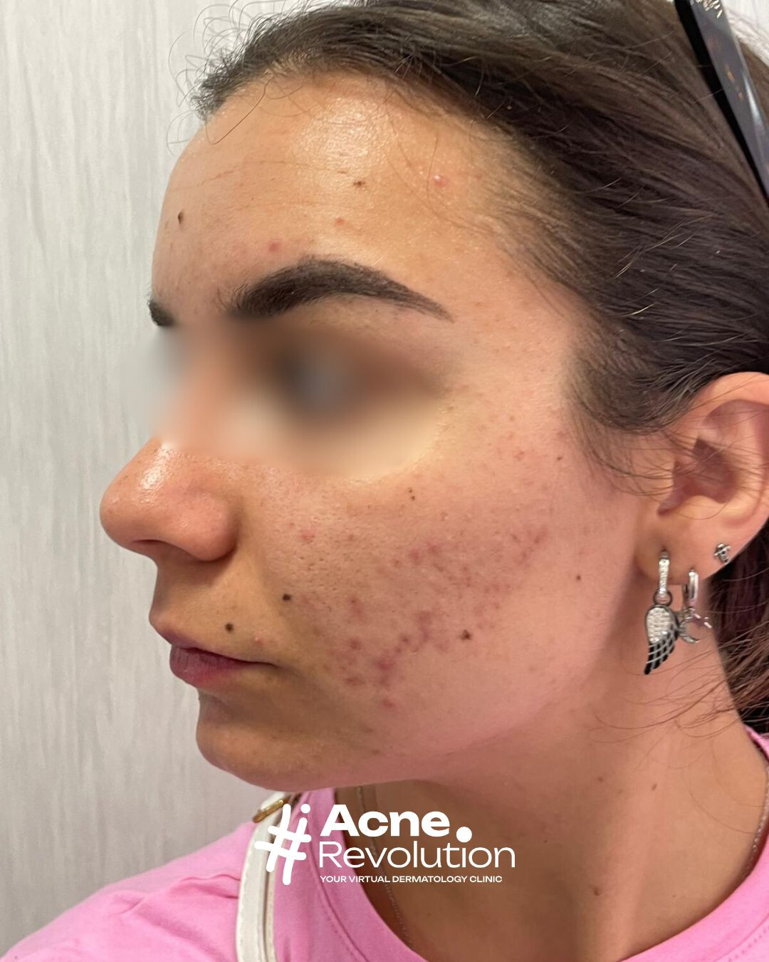 acne seborroica