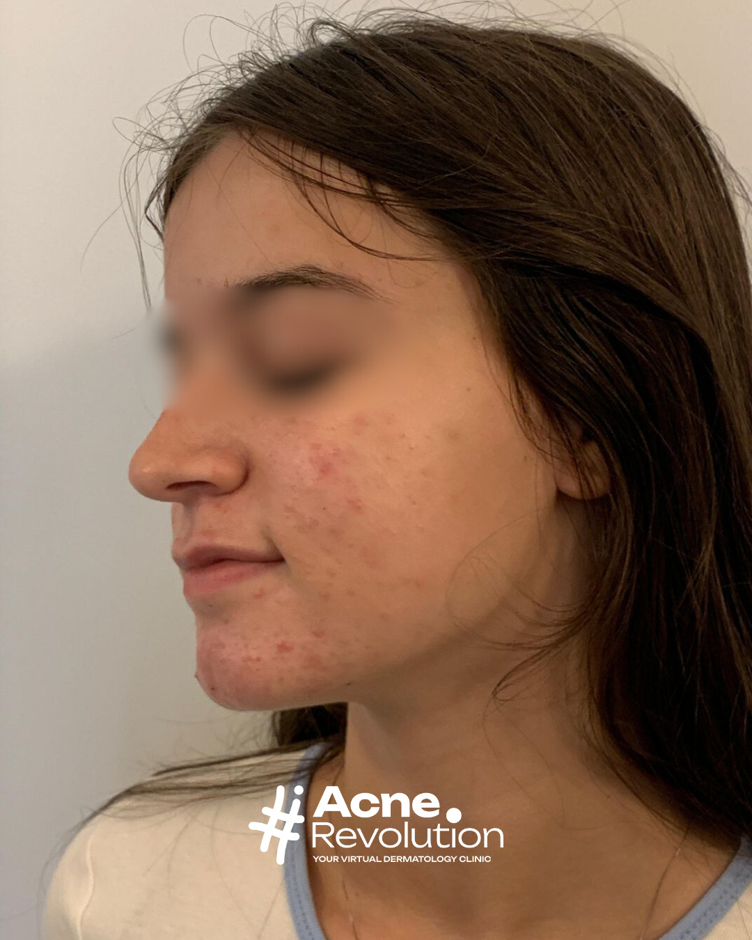 acne sottopelle