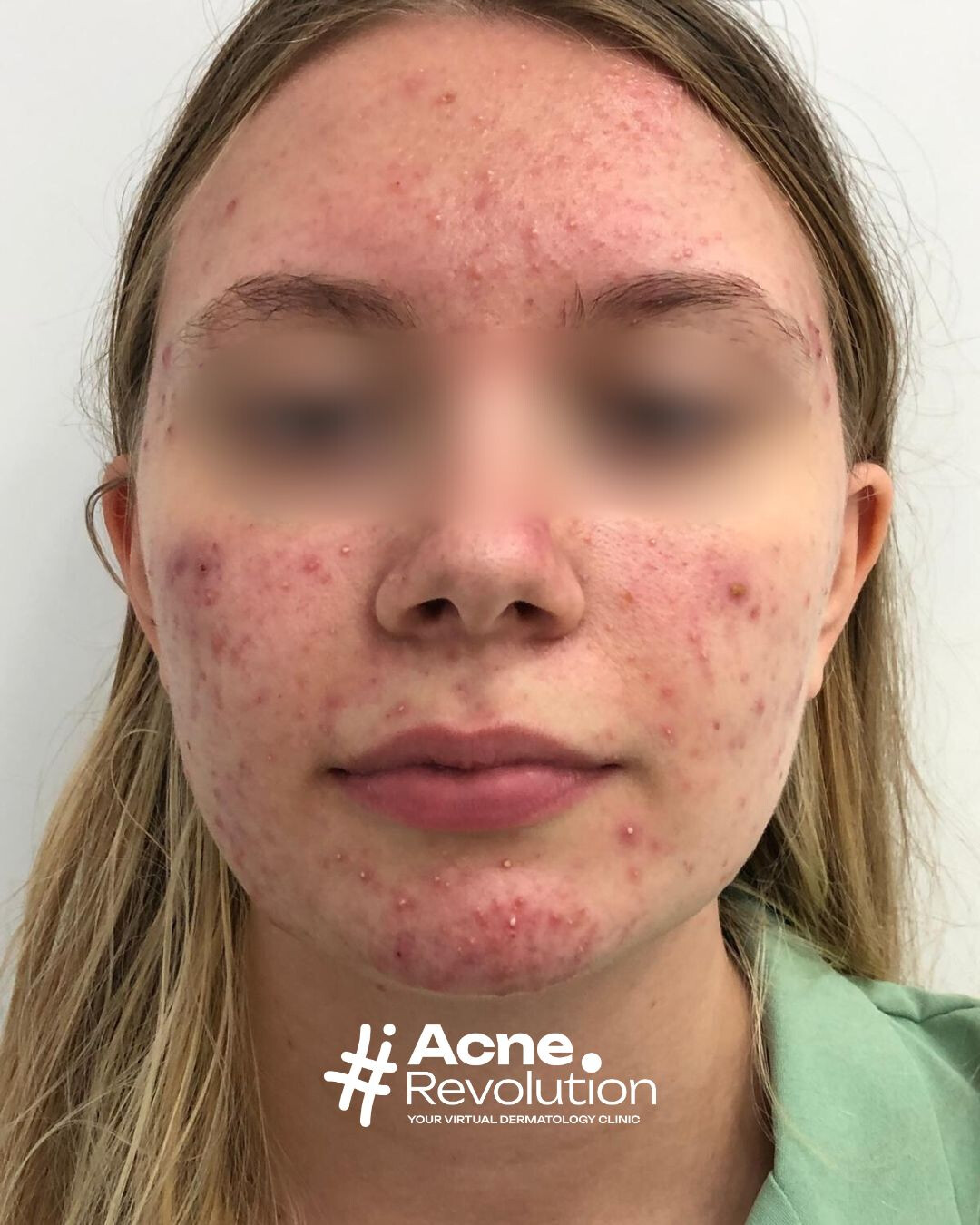 acne vulgaris