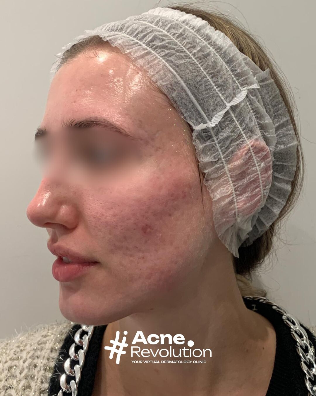 cicatrici da acne