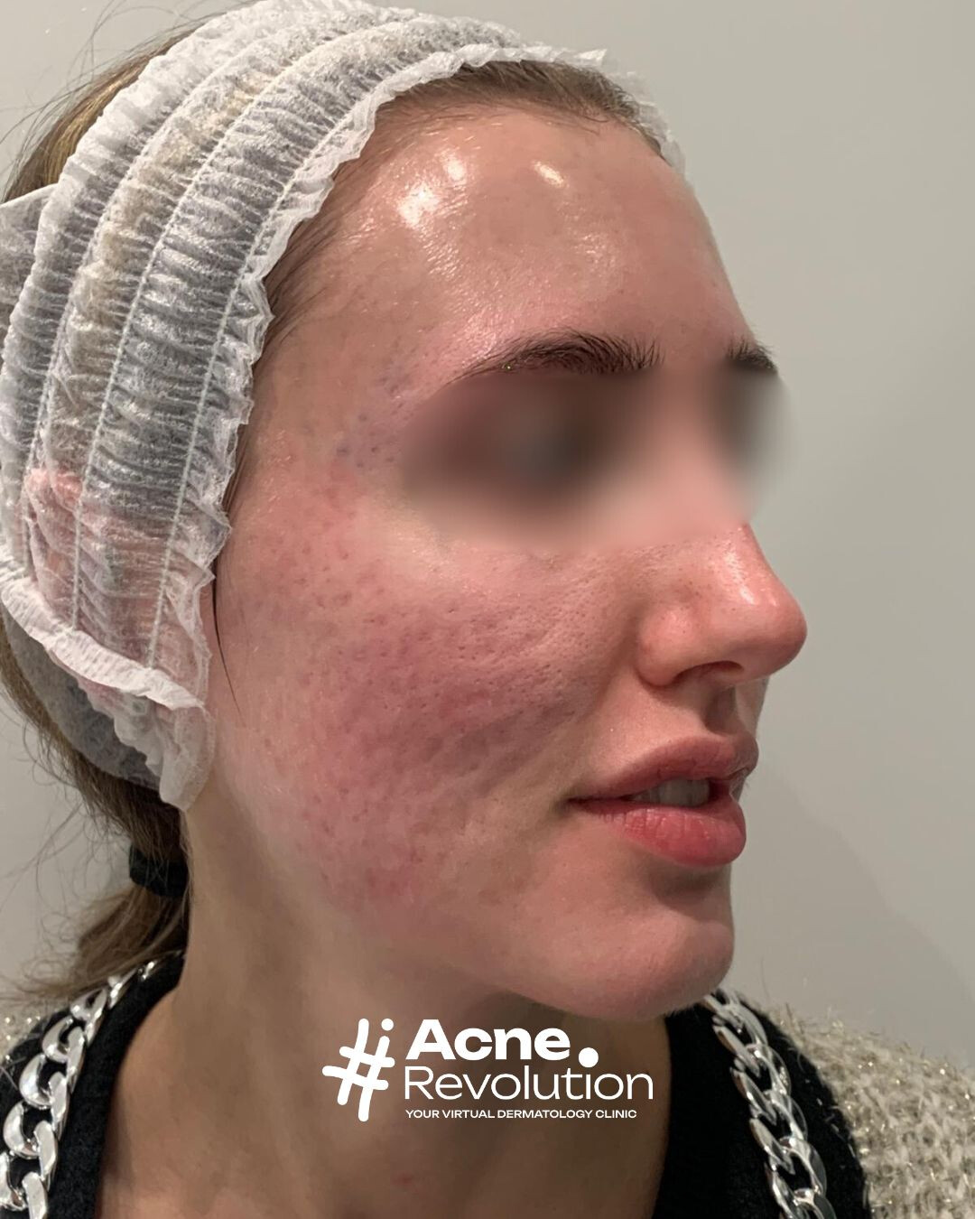 cicatrici da acne